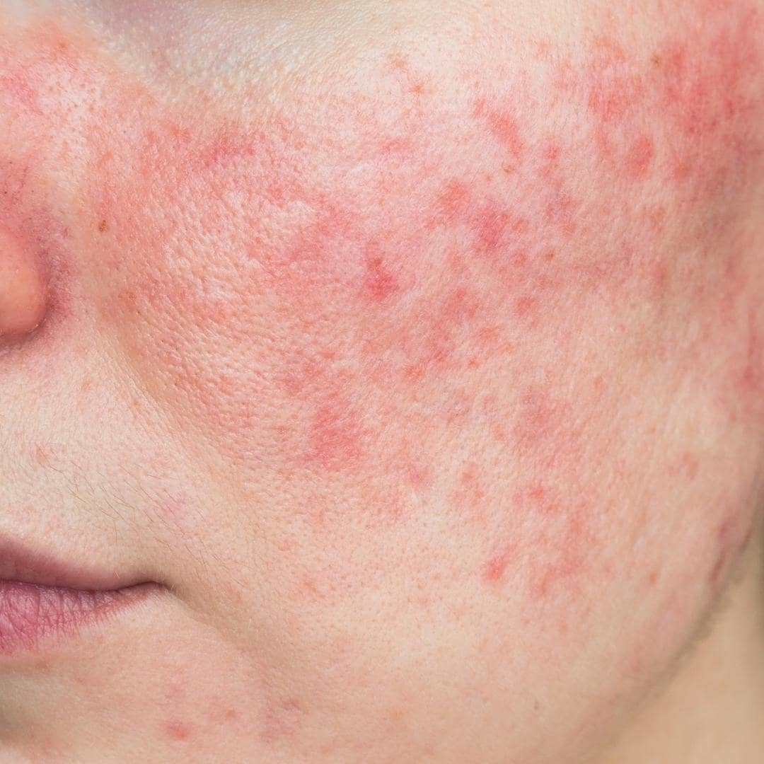 Rosacea