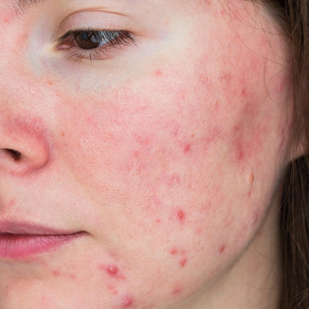 Rosacea